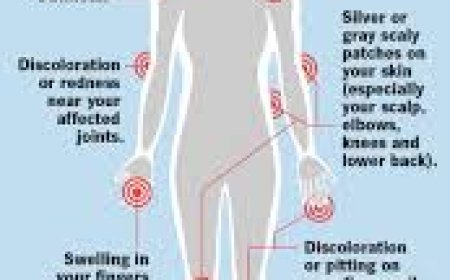Understanding Arthritis: Symptoms, Causes, and Management.