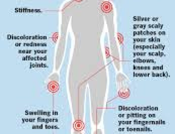 Understanding Arthritis: Symptoms, Causes, and Management.