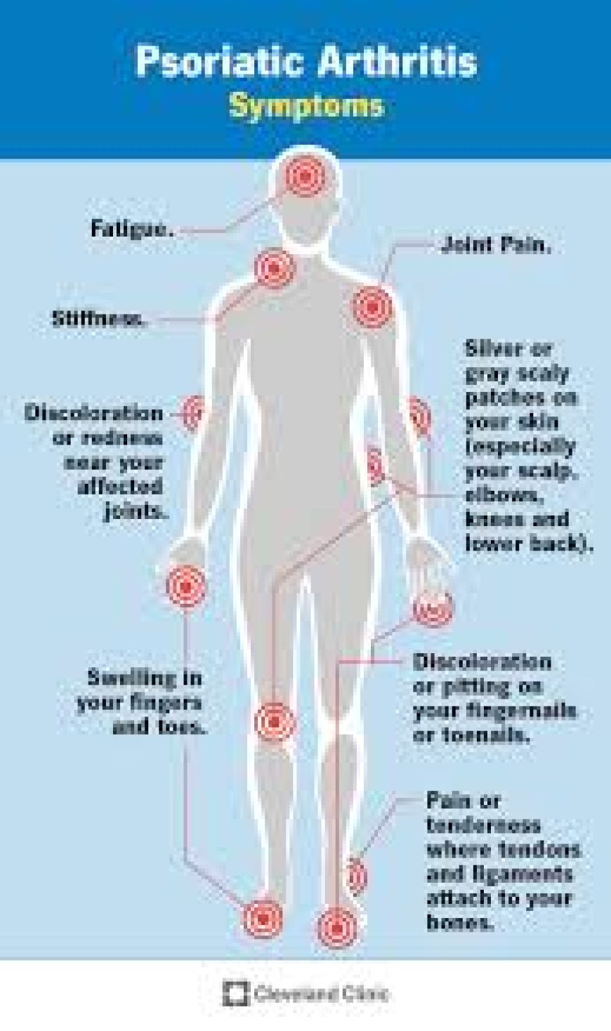 Understanding Arthritis: Symptoms, Causes, and Management.